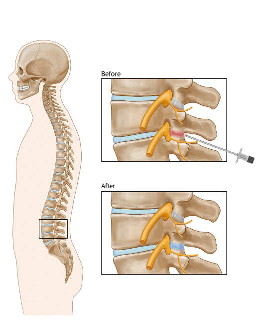 Lumbar Facet Joint Injection opt Pain Clinic of North Texas