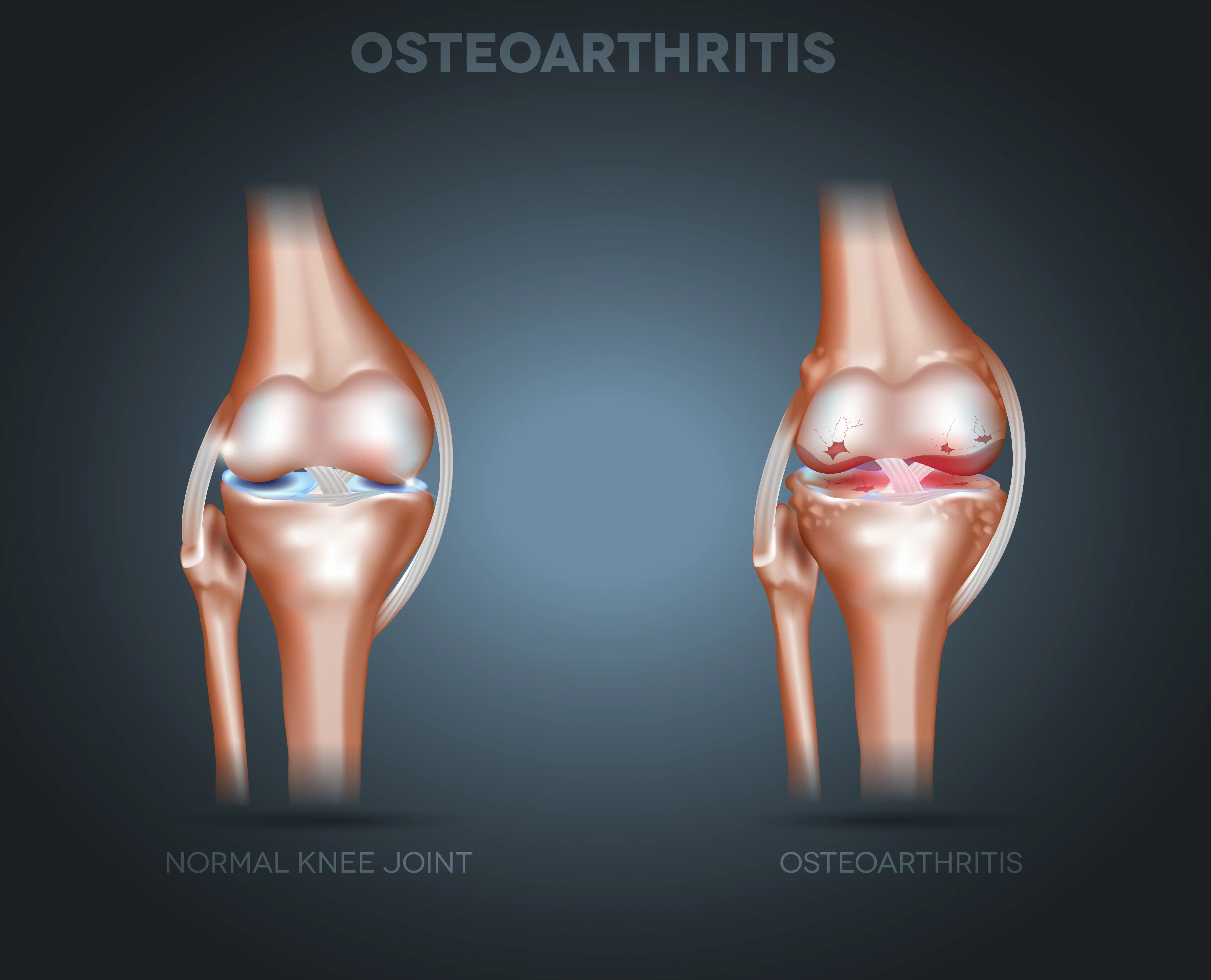 osteoarthritis in knee Pain Clinic of North Texas