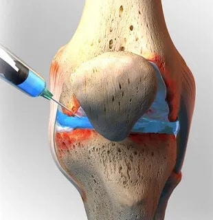 Knee Shot PRP Therapy Pain Clinic of North Texas & Dallas